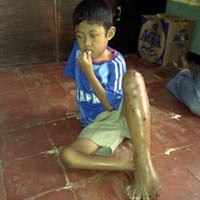 Akhirnya, Miftah Penderita Tumor Jalani Perawatan di RS Cengkareng