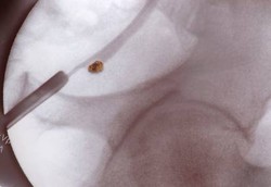 Punya Bakat Batu Ginjal? Cegah dengan Minum 3 Liter Air/hari