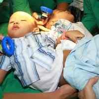 Operasi Pemisahan Bayi Kembar Dempet Pinggul Pecahkan Rekor