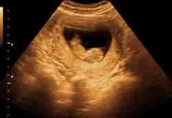 Mumi Janin Berdiam di Perut Wanita Selama 30 Tahun