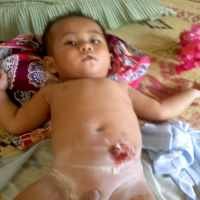 Ahmad Fahmi, Anak Pengayuh Becak Tak Miliki Anus