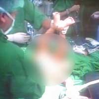 Kembar Siam Jombang Berhasil Dipisahkan