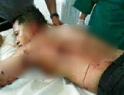 Dokter Angkat 30 Serpihan Bom dari Punggung Kapolres Cirebon