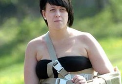 Tulang Bahu Copot 130 Kali Karena Tulangnya Terlalu Lemah