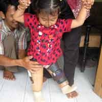 Senang Dapat Dua Kaki Palsu, Dewi Tak Sabar Ingin Sekolah