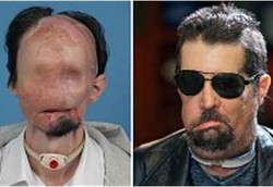 Pria Muka Rata Berubah Jadi Ganteng Usai Ditransplantasi