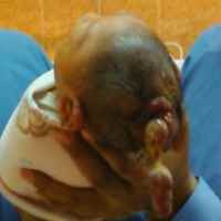 Bayi di Nganjuk Lahir dengan Jaringan Otak di Luar Kepala