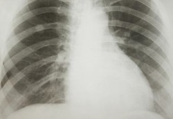 Kanker Paru Paling Dekat dengan Kematian