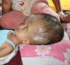 3 Tahun Didera Hydrocephalus, Imran Butuh Bantuan