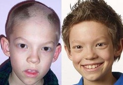 Bocah Hobi Cabuti Alis & Rambut Karena Gangguan Mental OCD