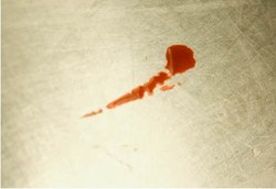 Hematidrosis si Penyakit Keringat Darah