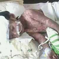 Konsumsi Obat RS Abdoer Rahem, Tubuh Balita 3,5 Tahun Melepuh