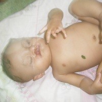 Bayi Suci Lestari di Garut Cacat Fisik Sekujur Tubuh