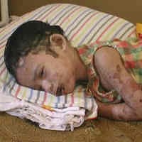 2 Minggu Dirawat, Kondisi Tubuh Balita 3,5 Tahun Melepuh Masih Lemah