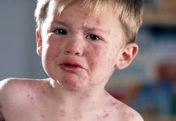 Demam Scarlet, yang Muncul Bareng Radang Tenggorokan 