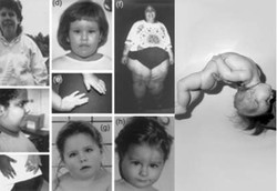 Sindrom Prader-Willi, Kelainan Genetis yang Langka