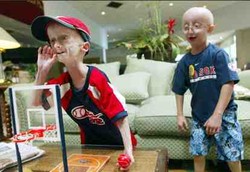 Progeria, Menjadi Tua Saat Masih Anak-anak