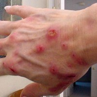 Hasil gambar untuk penyakit Morgellons Disease