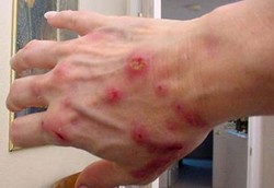 Morgellons, si Penyakit Kulit yang Misterius