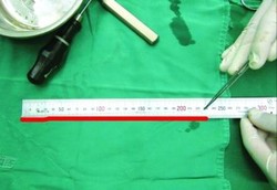 Sering Epilepsi, Ternyata Ada Cacing 23 Cm di Otaknya