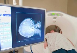 Kanker Otak dan Ciri-cirinya