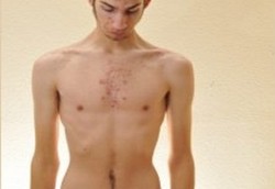 Laki-laki Juga Bisa Kena Gangguan Makan Anoreksia