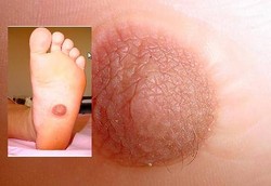 Puting Susu Tumbuh di Telapak Kaki