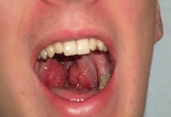 Amandel Raksasa Melebihi Bola Pingpong