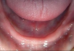 Anodonsia, Penyakit Tidak Tumbuhnya Gigi