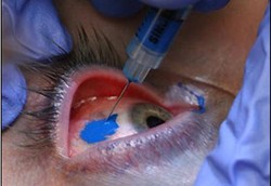 Tato Mata, Melukis Kornea Mata Tapi Berisiko Buta