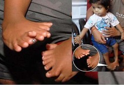 Punya 34 Jari Tapi Tidak Punya Jempol