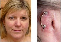 Kehilangan Telinga Karena Kecanduan Berjemur Matahari