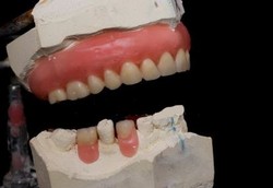 Gingivitis, Penyakit Radang Gusi yang Bengkak dan Merah