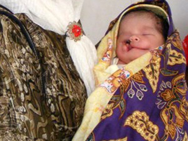 Anisa Penderita Bibir Sumbing Anisa Penderita Bibir Sumbing