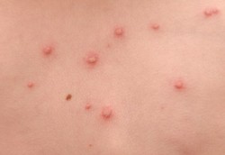 Acyclovir Liquid, Obat untuk Herpes dan Cacar Air