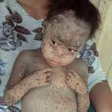 Kulit Bersisik Pada Rohim Hanya Terjadi 1:300 Ribu Bayi