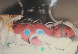 Bayi Lahir Hampir Tanpa Memiliki Darah di Tubuhnya