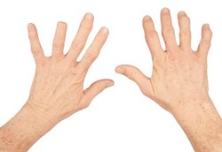 Penyebab Penyakit Autoimun Mulai Terungkap