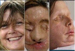 Wajah Hancur Dicakar Monyet Pulih Berkat Face Lift 