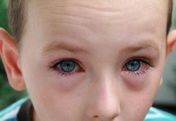 Konjungtivitis, si Mata Belekan