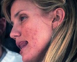 5 Penampilan Selebriti Terburuk Saat Berjerawat