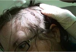 Memilih Tidak Dibius Saat Operasi Bedah Tumor Otak