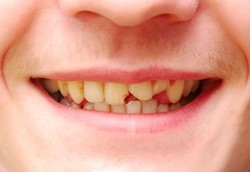 Gigi Bisa Berubah Warna Karena Ini
