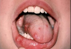 Penyakit Behcet Sebabkan Peradangan Pembuluh Darah