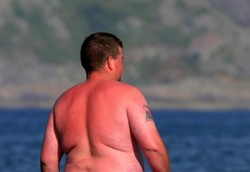 Porfiria, Kulit Melepuh Terkena Sinar Matahari