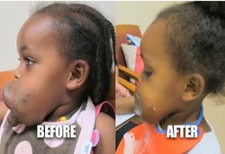 Bocah Ethiopia Berwajah Ngeri Karena Membesarnya Pembuluh Darah