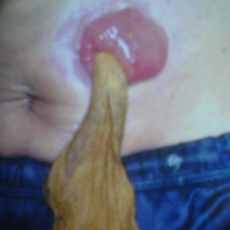 Usai Operasi Kanker Serviks, Benda Mirip Kasa Keluar Dari Perut