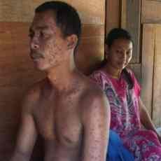 Lebih 100 Warga Satu Desa di 7 Dusun Terserang Cacar Air