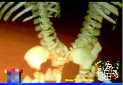 Dokter AS Pisahkan Kembar Siam dengan 1 Tulang Punggung