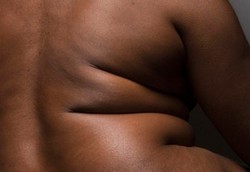 Acanthosis Nigricans, Lipatan Kulit Gelap dan Tebal Seperti Beludru